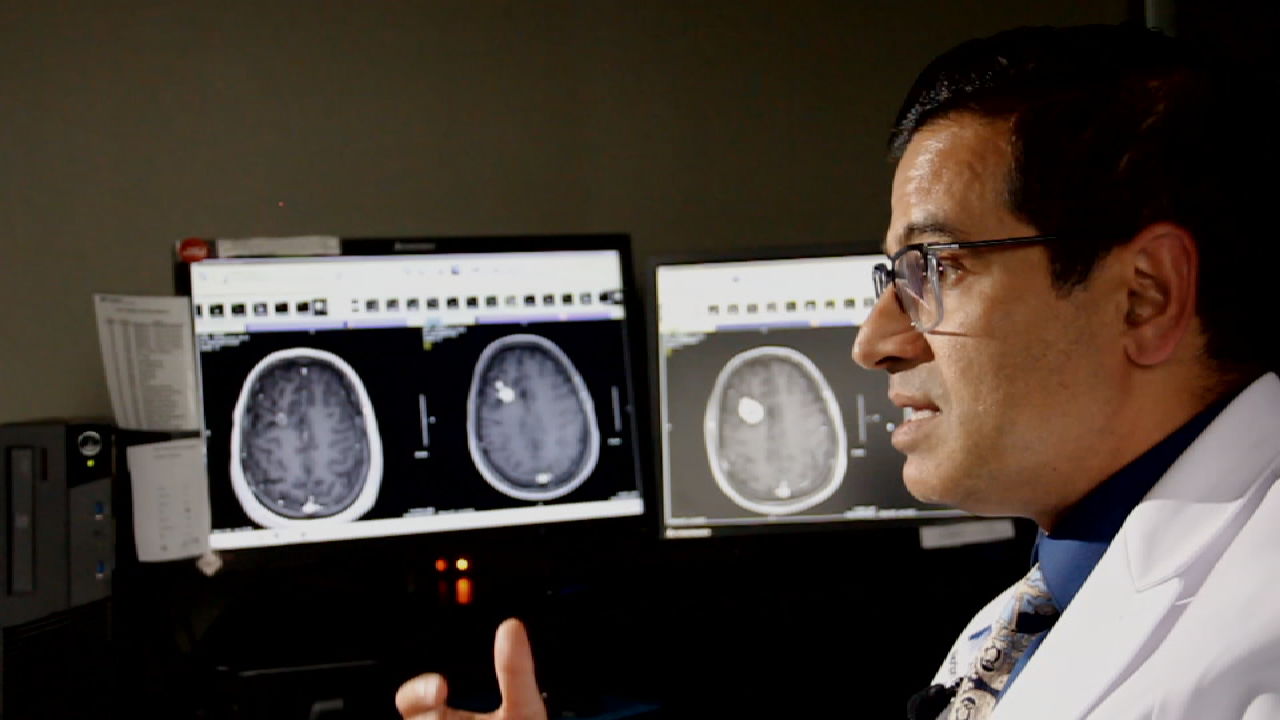 Louisville doctor seeing 'remarkable' results from new treatment for serious brain condition